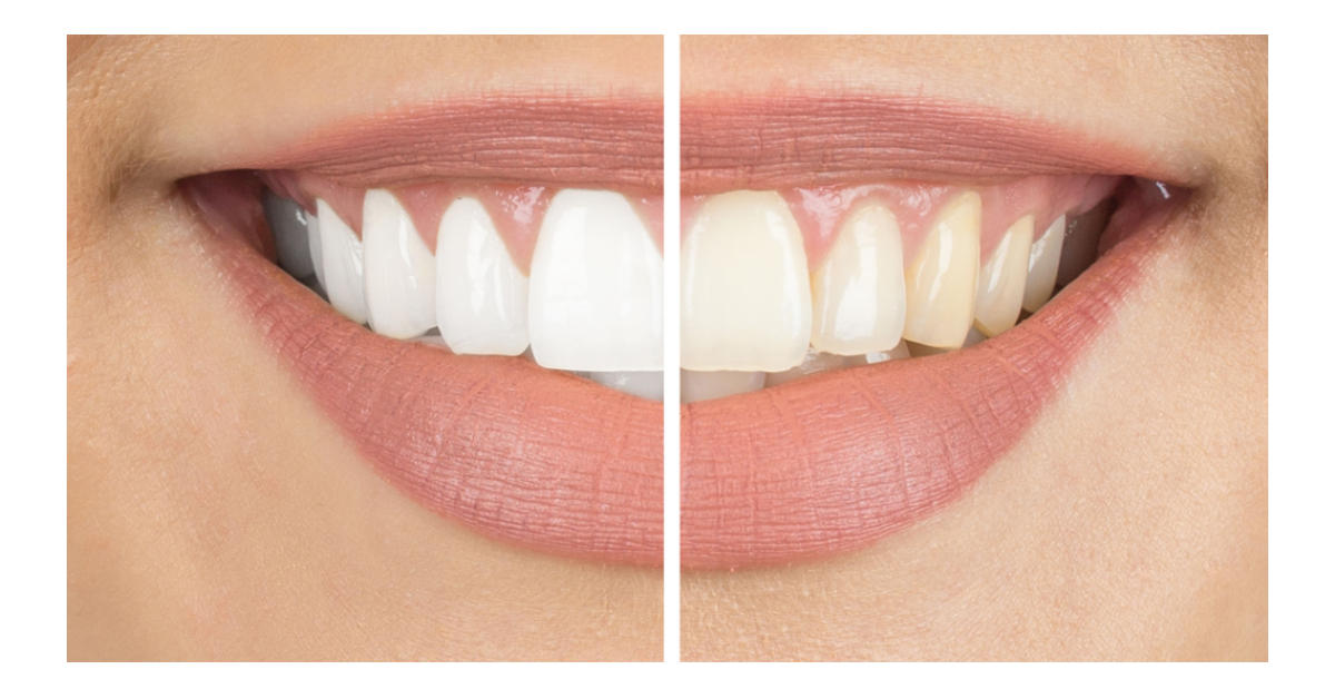 blanqueamiento dental 7