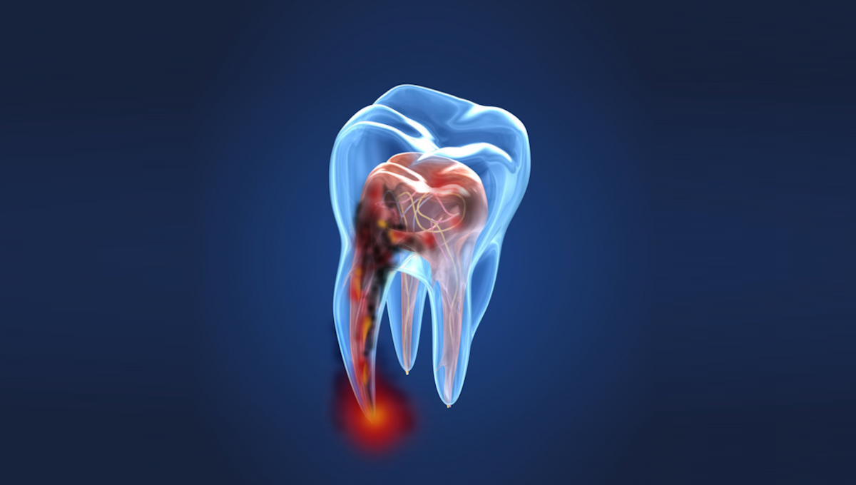 endodoncia-clinica-castan-dental